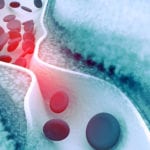 Cholesterol plaque in artery